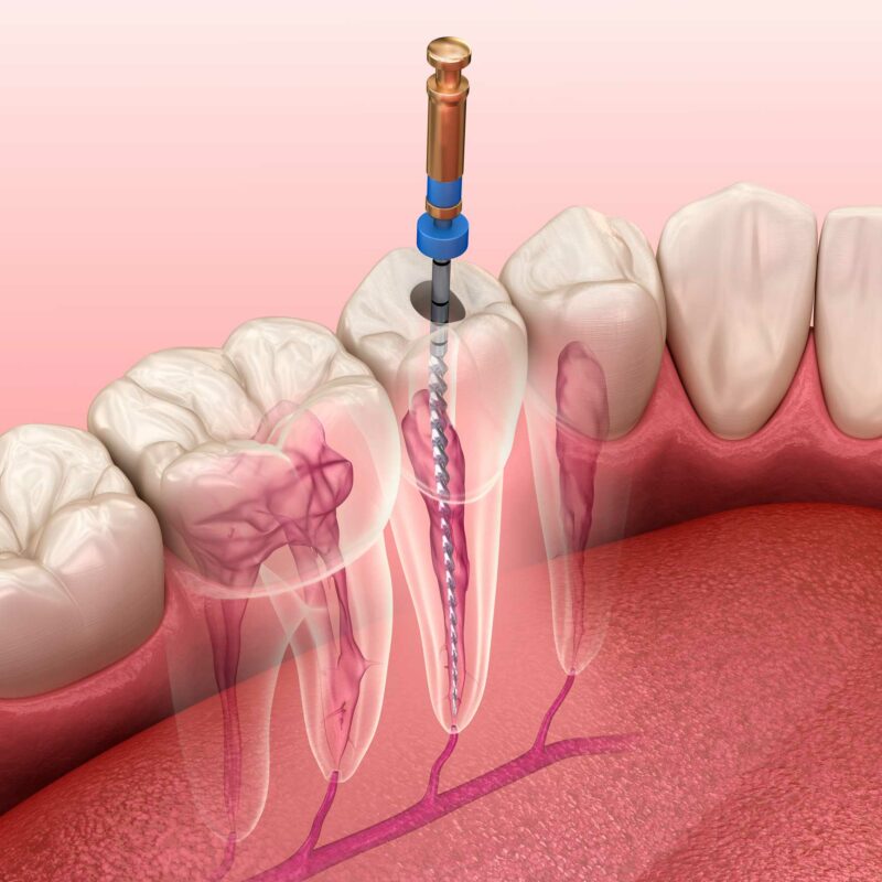 Endodoncia en Ronda , clínica dental en Ronda